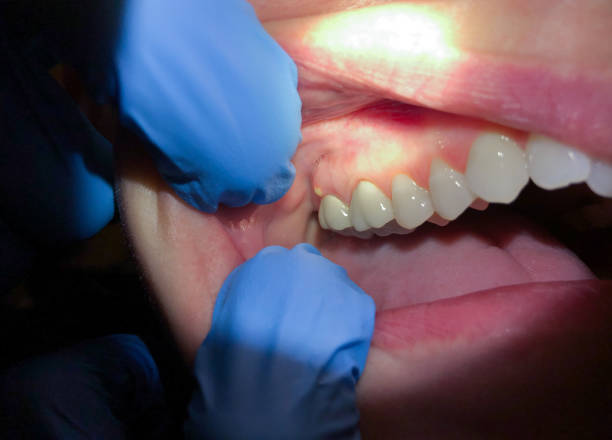 Best Emergency Wisdom Tooth Extraction in West Tawakoni, TX